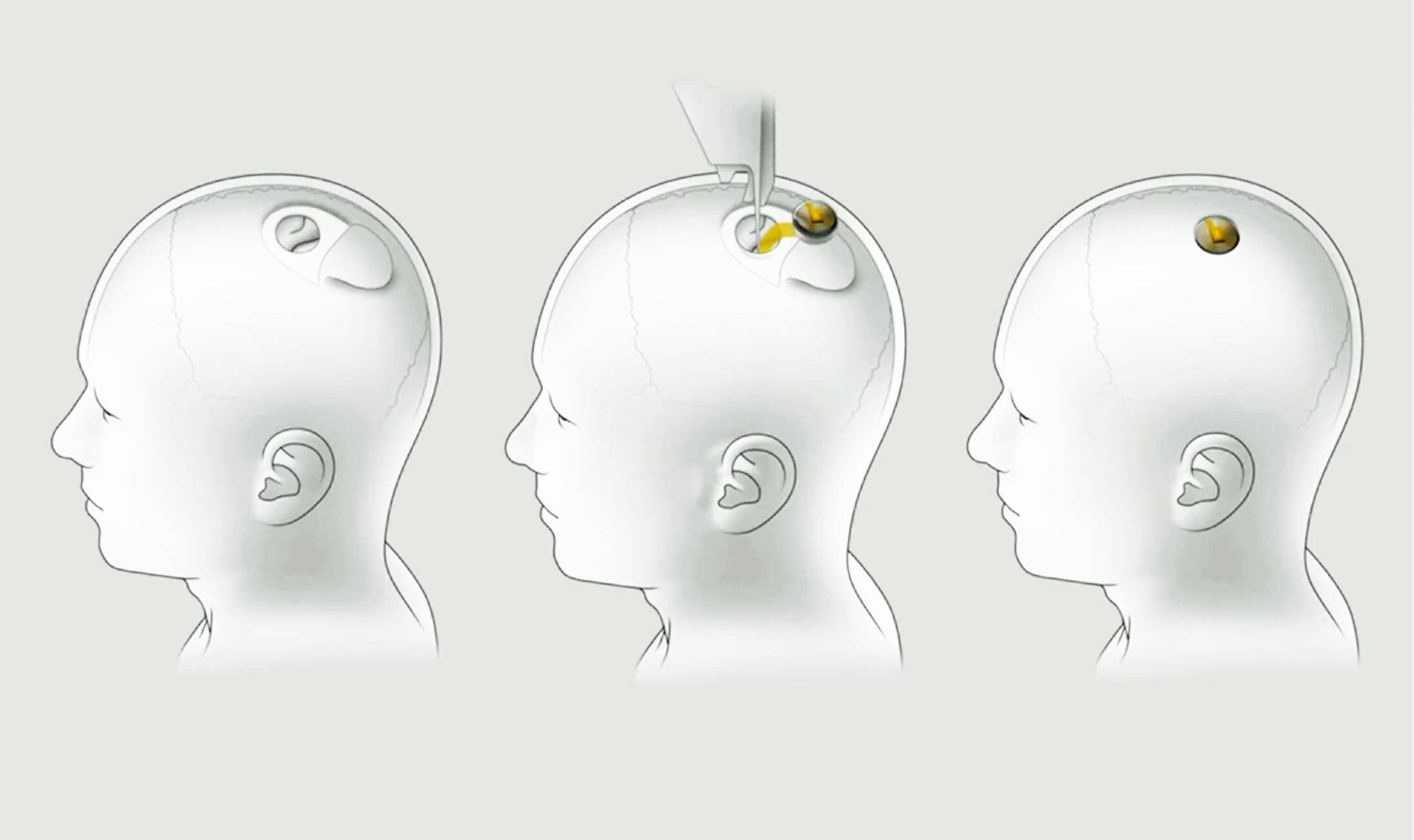Neuralink's brain-machine interface technology sinks electrodes into the brain then uses a chip to communicate with computers outside your skull.
Screenshot by Luke Wilson/Fargolife